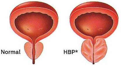 Comparación próstata normal y hbp
